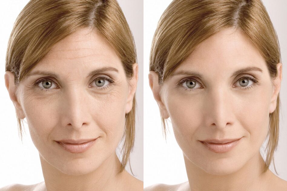 Experiences of using before and after using Milana's intenskin cream