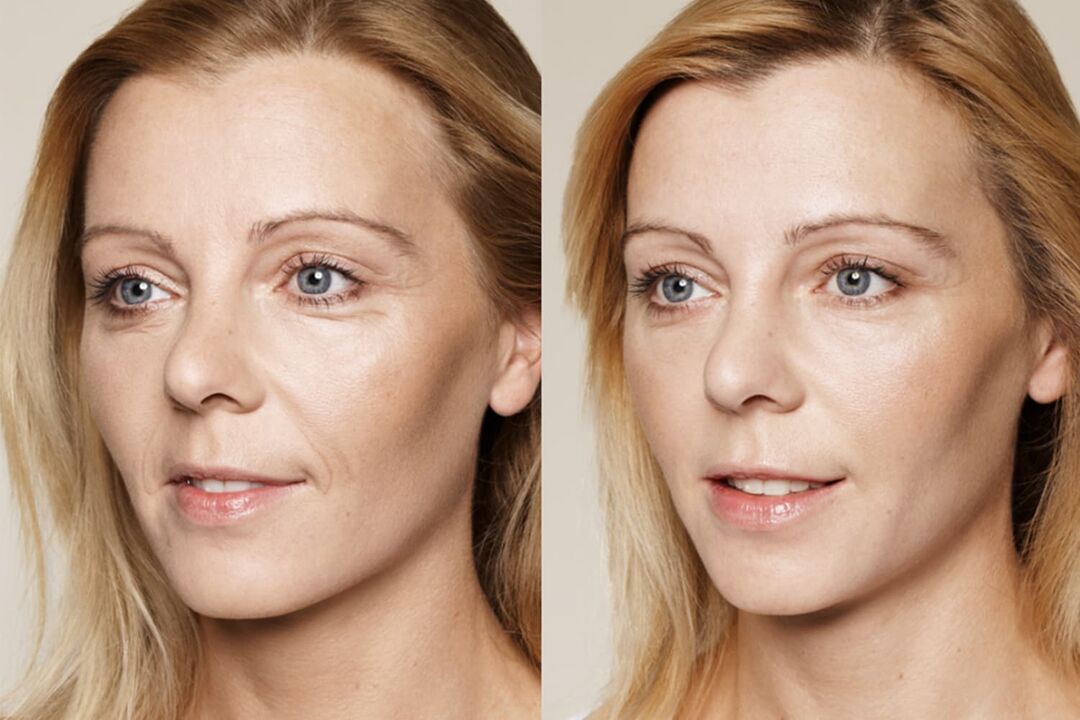 Experiences with the use before and after using Valeria's intenskin cream